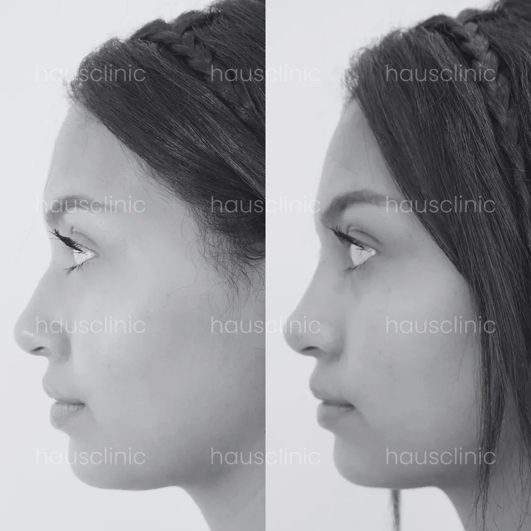 Rinoplastia sin cirugía: una nariz perfecta, adiós trucos de maquillaje para la Nariz.