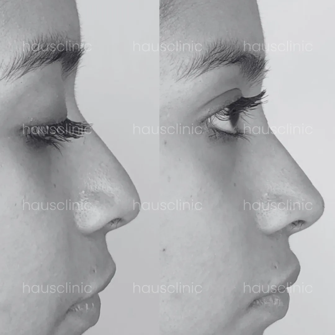 Transformación nasal con rinomodelación en HAUS Clinic Barcelona - Resultados inmediatos sin cirugía invasiva.