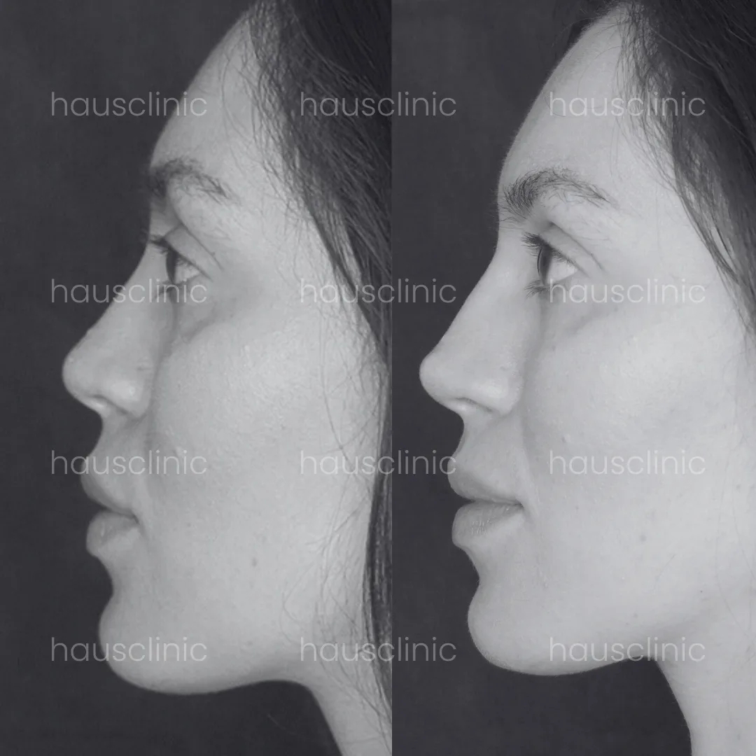 Rinomodelación no quirúrgica en HAUS Clinic Barcelona - Transformación nasal rápida y segura.