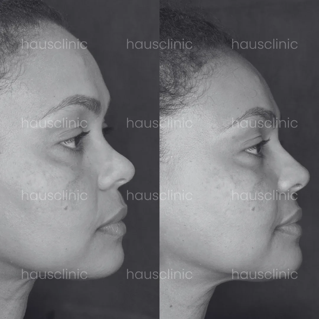 Secretos de una Nariz perfecta: la rinomodelación con ácido hialurónico en HAUS Clinic Barcelona by Dr Emiliano Alvarez.