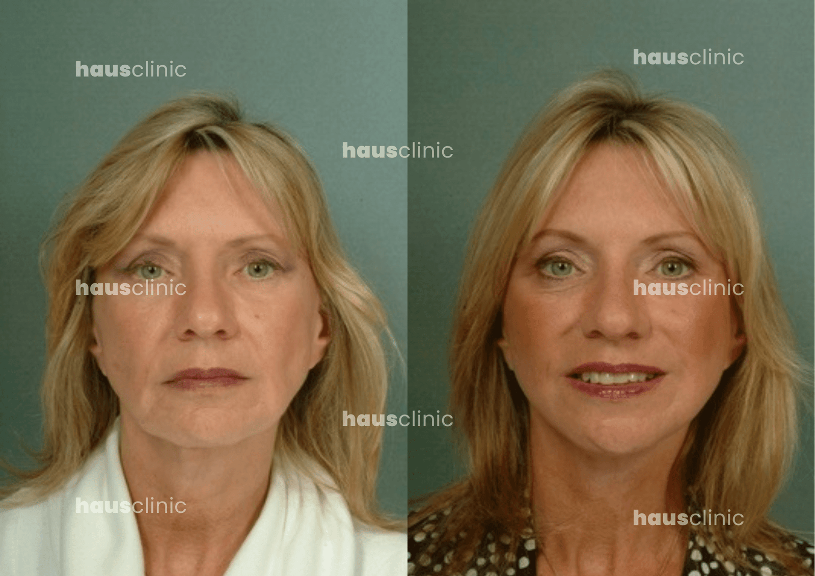 Rejuvenecimiento facial con láser: El secreto médico para recuperar la juventud de tu piel sin cirugía 2 rejuvenecimiento facial con láser