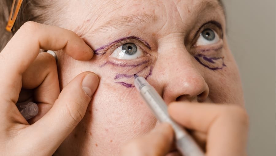 Los Párpados: ¿Que tipos de Blefaroplastias existen?Tipos de Blefaroplastia en Barcelona: Rejuvenece tus Párpados con Técnicas AvanzadasLos Párpados: ¿Que tipos de Blefaroplastias existen?