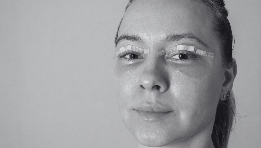 10 Años Más Joven: ¡Descubre la Blefaroplastia para una Mirada Rejuvenecida!