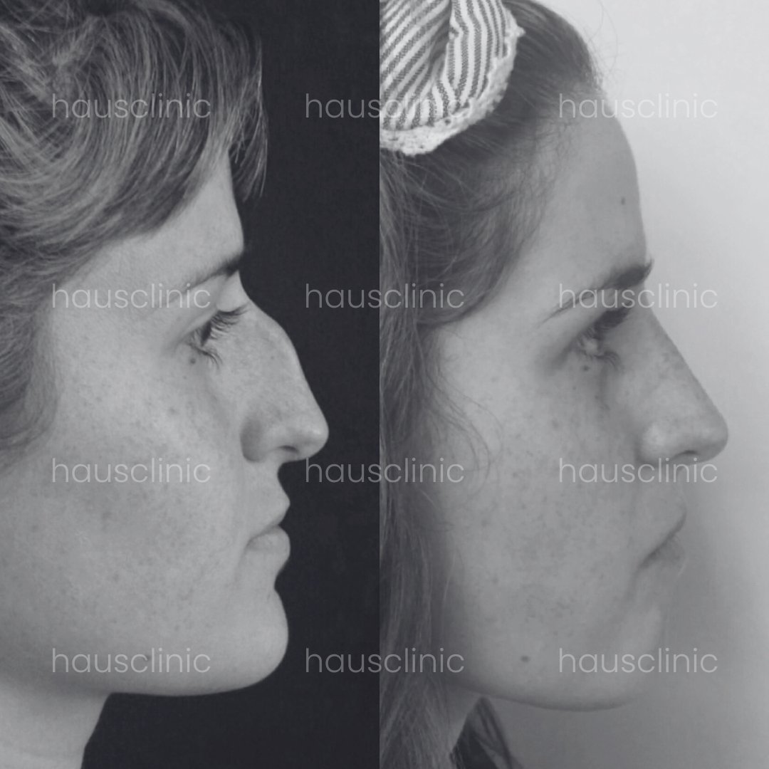 Rinoplastia sin cicatrices para resultados naturales.